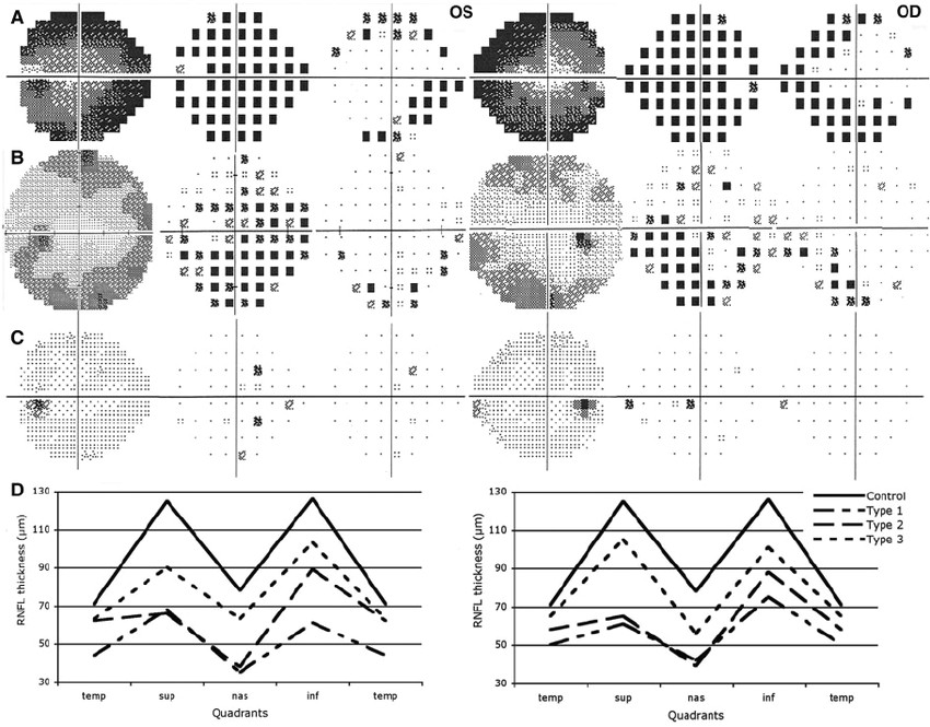 Drawing An Eye Ks1 Full Threshold 24 and 30 Visual Field Of the Right Eye Od Left