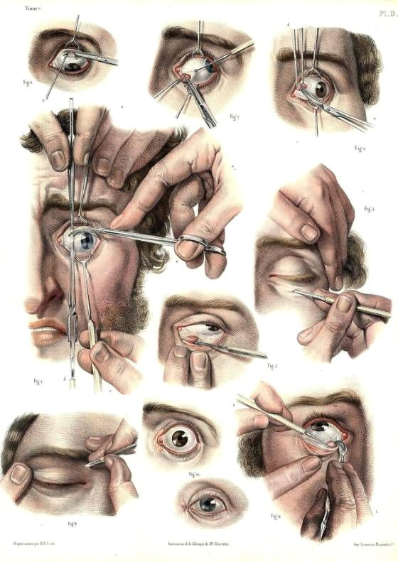 Drawing Lazy Eye 2 Surgical Technique for Correcting A Lazy Eye From Traite