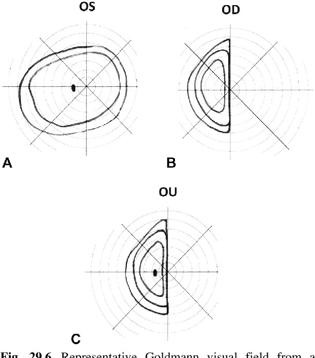 Drawing Left Eye Figure 29 6 From Functional and Simulated Visual Loss Semantic