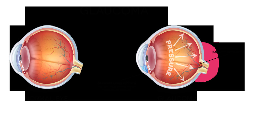 Drawing Of Eye Drops Glaucoma Bva Advanced Eye Care