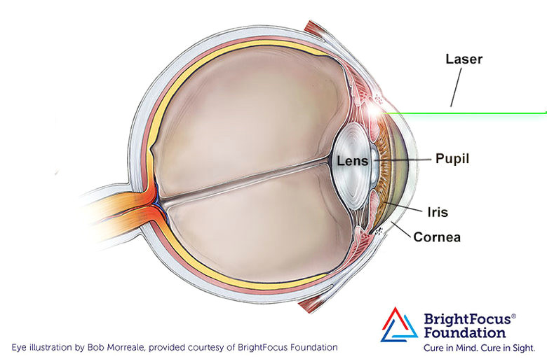 Drawing Of Eye Drops Peripheral Iridotomy A Laser Surgery for Narrow Angle Glaucoma