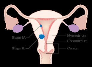 Drawing Of Heart Cancer Endometrial Cancer Wikipedia