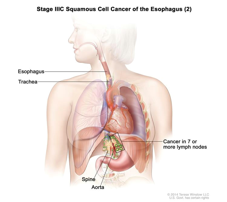 Drawing Of Heart Cancer Esophageal Cancer