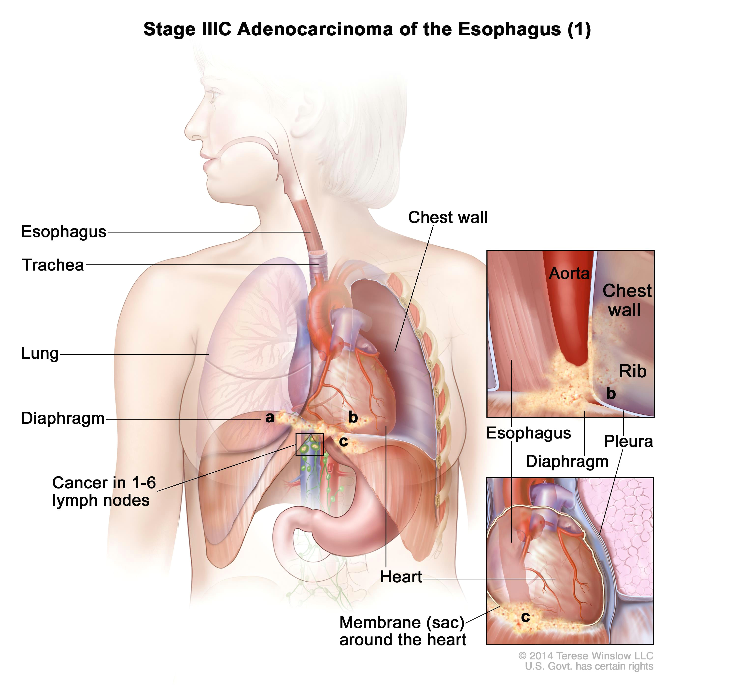 Drawing Of Heart Cancer Esophageal Cancer