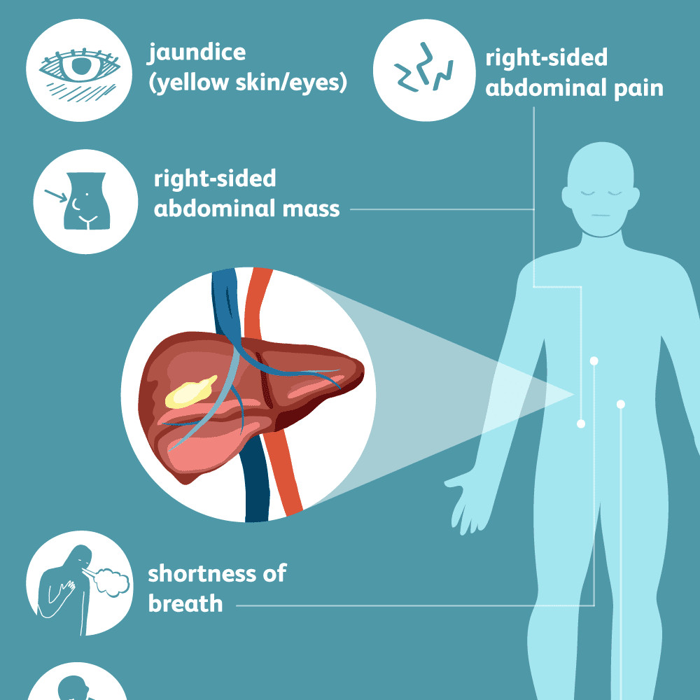 Drawing Of Heart Cancer Liver Cancer Signs Symptoms and Complications