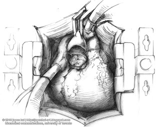 Drawing Of Open Heart Surgery A R T P O O P A G E Open Heart Surgery