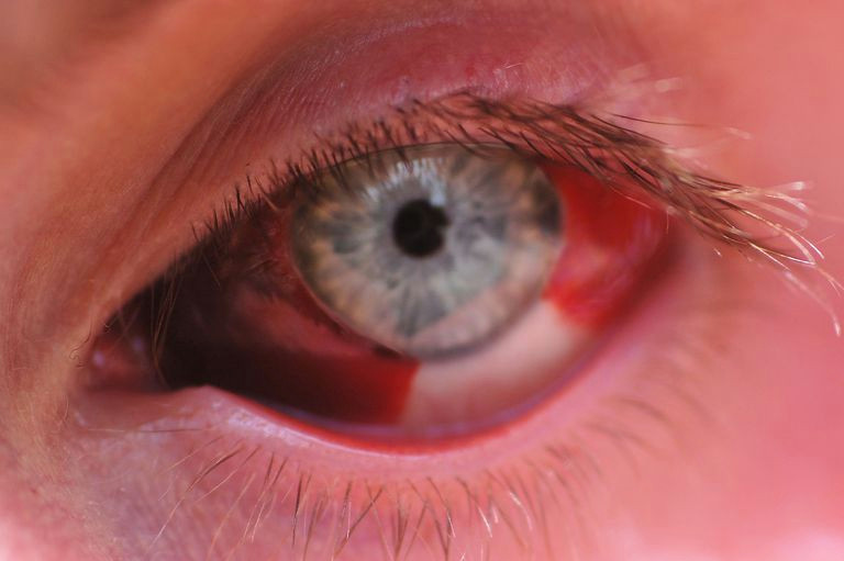 Drawing Out Eye Infection Causes Of Bloody Tears or Haemolacria