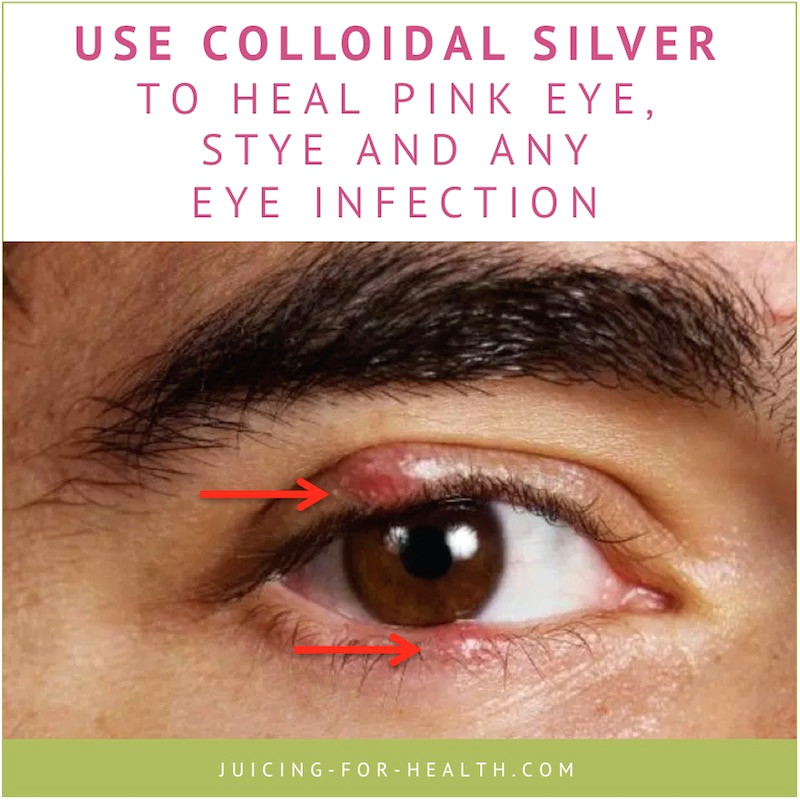 Drawing Out Eye Infection Colloidal Silver Heal Eye Infections Fast How to Use It Safely and