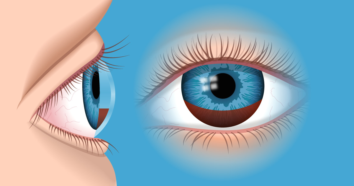 Drawing Out Eye Infection Hyphema