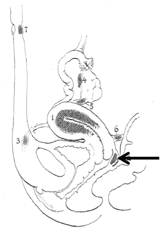 Drawing T-s Diagram Sagittal Drawing Of the Pelvis with Arrow Pointing to Endometriosis