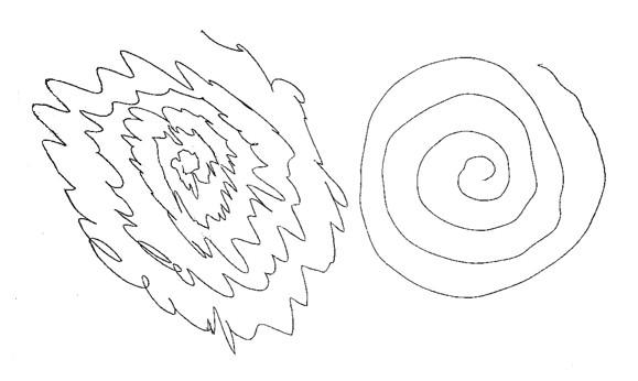 S Drawing From the 90s Essential Tremor Wikipedia