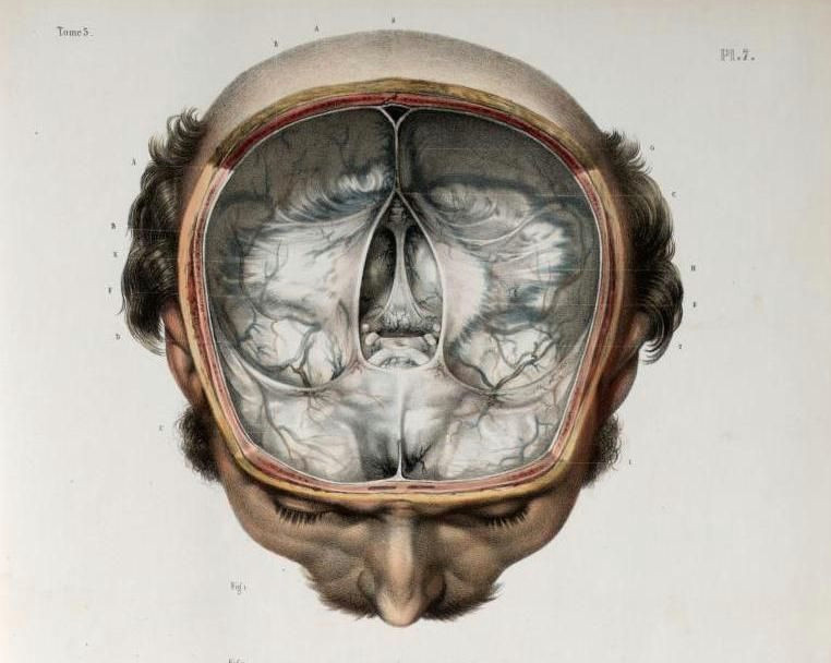 Skull Drawing Brain Skull Divided to Remove Anterior Hemisphere Brain Removed to Show