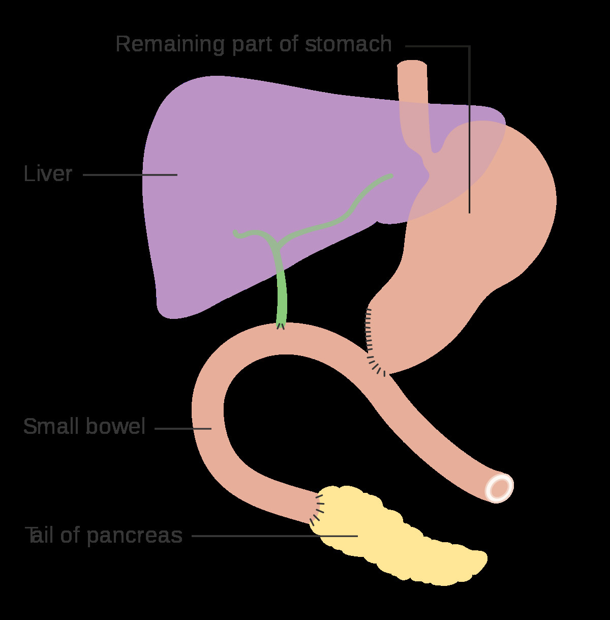 Pancreas Drawing Easy Pancreaticoduodenectomy Wikipedia