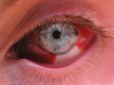 Drawing Out Eye Infection Causes Of Bloody Tears or Haemolacria